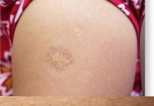 Svi rođeni u Jugoslaviji imaju ovaj ožiljak na ruci: Znate li kako je nastao i zbog čega? Svi su iznenađeni