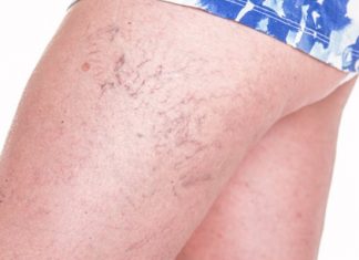 Svatko kod kuće ima lijek za popucale kapilare, ali mnogi ljudi to ne znaju!