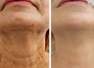 Čarobno ulje protiv starenja, Zaglađuje sve bore na licu snažnije od botoksa