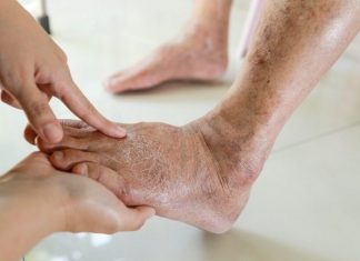 7 znakova da se tijelo već duže vrijeme bori s VISOKIM ŠEĆEROM U KRVI: Prvo ćete to primijetiti na očima i nogama! (FOTO)