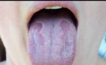 ZAUVIJEK SE RIJEŠITE KANDIDE: Ovaj recept se rješava ove opasne gljivice!