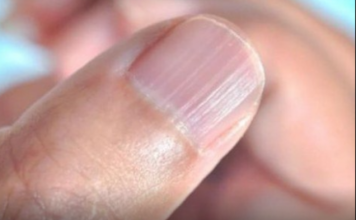 IMATE LI OVAKVE IZBOČINE NA NOKTIMA – evo šta one znače: Doktorica otkrila i možda ćete se iznenaditi