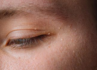 Uklanjaju se jednstavno, TREBAJU VAM 3 SASTOJKA KOJA IMATE U KUĆI – NI SLUČAJNO IH NE ISTISKUJTE,AKO IMATE OVE BIJELE TAČKICE NA LICU!