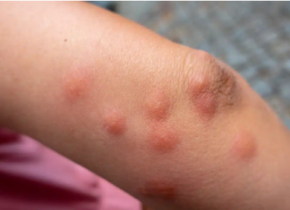 Ovo su znakovi da u kući imate stjenice: EVO KAKO DA IH SE MOMENTALNO RIJEŠITE