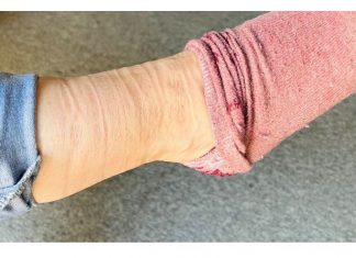 Uz pomoć OVOG minerala ispuhaćete se kao balon – LJETI SE VODA GOMILA U NOGAMA I STOMAKU!