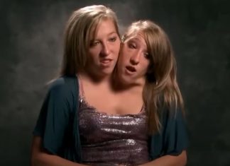 Porodile se najpoznatije sijamske bliznakinje? Jedna se udala pre 4 godine, a trudnoću krile!!!!!