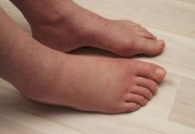 LJETI SE VODA GOMILA U NOGAMA I STOMAKU: Uz pomoć ovog minerala izduvaćete se kao balon