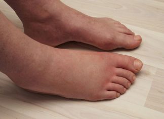 LJETI SE VODA GOMILA U NOGAMA I STOMAKU: Uz pomoć ovog minerala izduvaćete se kao balon