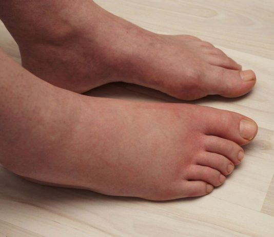 LJETI SE VODA GOMILA U NOGAMA I STOMAKU: Uz pomoć ovog minerala izduvaćete se kao balon