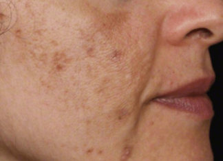 Evo kako da sa ovim jednostavnim trikom od 2 sastojka izbrišete mrlje s kože!