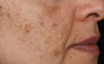 Evo kako da sa ovim jednostavnim trikom od 2 sastojka izbrišete mrlje s kože!