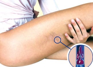 KAKO PREPOZNATI SIMPTOME TROMBA? Ovo su znakovi na koje trebate obratiti pažnju: Kada se krvni ugrušak nađe u blizini srca javljaju se sljedeći simptomi