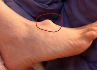 KVRŽICE NA NOZI MOGU DA UKAŽU NA PO ŽIVOT OPASNO STANJE: Ne ignorišite ove simptome