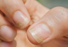 Promene na noktima ruku