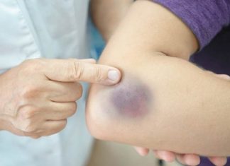 MODRICE JAVLJAJU PO TIJELU: NEMA VEZE SA POVREDAMA, PRAVI RAZLOG ĆE VAS ŠOKIRATI