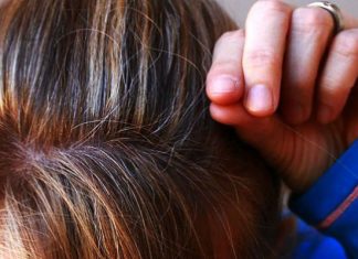 BUBULJICE NA GLAVI SU SVE ČEŠĆI PROBLEM: Ni slučajno ih ne istiskujte, evo zašto se javljaju I ŠTA TREBATE URADITI DA NESTANU