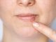 Kada herpes prestaje biti zarazan? Evo što trebate znati
