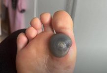 Velika modrica ili krvni žulj na stopalu kod deteta: uzroci, simptomi i kako postupiti