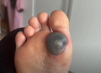 Velika modrica ili krvni žulj na stopalu kod deteta: uzroci, simptomi i kako postupiti