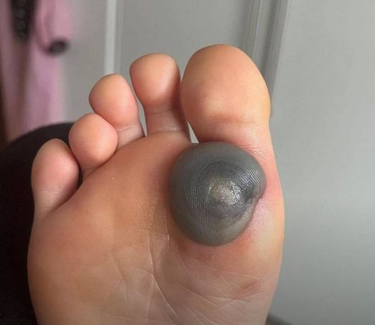 Velika modrica ili krvni žulj na stopalu kod deteta: uzroci, simptomi i kako postupiti