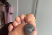 Velika modrica ili krvni žulj na stopalu kod deteta: uzroci, simptomi i kako postupiti