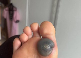 Velika modrica ili krvni žulj na stopalu kod deteta: uzroci, simptomi i kako postupiti