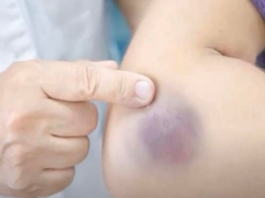 NIKAD NE BISTE POGODILI ZAŠTO SE MODRICE JAVLJAJU PO TIJELU: Nema Veze Sa POVREDAMA, PRAVI RAZLOG ĆE VAS ŠOKIRATI