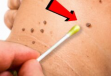 Prirodno ulje za uklanjanje papiloma, bradavica i gljivica: Svaka kap je neprocjenjiva!