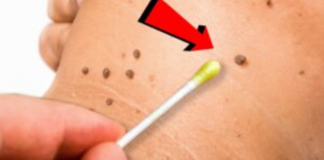 Prirodno ulje za uklanjanje papiloma, bradavica i gljivica: Svaka kap je neprocjenjiva!