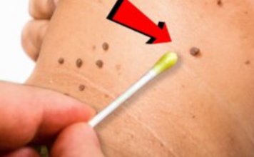 Prirodno ulje za uklanjanje papiloma, bradavica i gljivica: Svaka kap je neprocjenjiva!