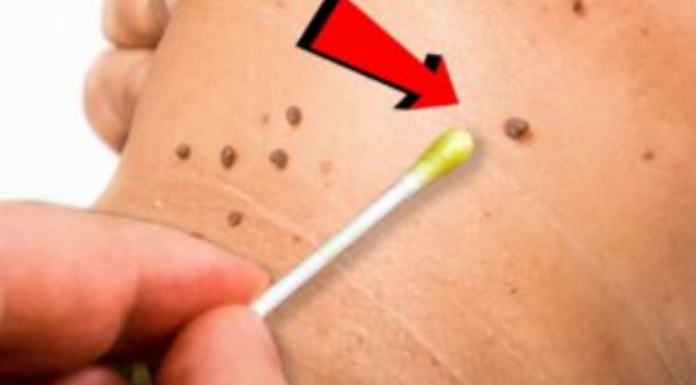 Prirodno ulje za uklanjanje papiloma, bradavica i gljivica: Svaka kap je neprocjenjiva!