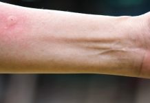 Ubod stršljena ga odveo na rub smrti,Ispovijest muškarca kojeg je napao roj stršljena ledi krv u žilama: “Srce mi je prestalo kucati, ali čudo me vratilo!