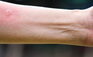 Ubod stršljena ga odveo na rub smrti,Ispovijest muškarca kojeg je napao roj stršljena ledi krv u žilama: “Srce mi je prestalo kucati, ali čudo me vratilo!