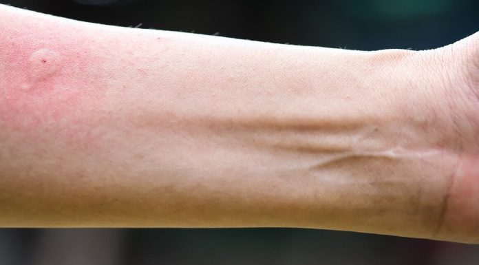 Ubod stršljena ga odveo na rub smrti,Ispovijest muškarca kojeg je napao roj stršljena ledi krv u žilama: “Srce mi je prestalo kucati, ali čudo me vratilo!