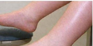 DA IZBACITE VIŠAK VODE POTREBAN VAM JE JEDAN VITAMIN: Ni noge vam više neće oticati, samo ga ubacite u ishranu DA IZBACITE VIŠAK VODE POTREBAN VAM JE JEDAN VITAMIN: Ni noge vam više neće oticati, samo ga ubacite u ishranu - featured image