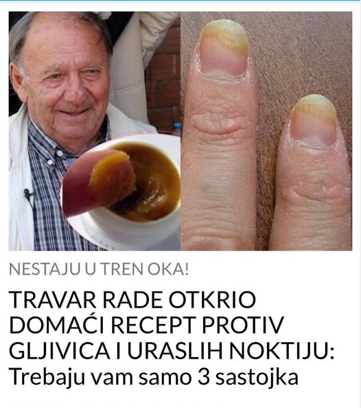 P0ZNATl TRAVAR 0TKRI0 D0MAĆI RECEPT PR0TIV GLJIVICA I URASLIH N0KTIJU: Trebaju vam OVA 3 sastojka - featured image P0ZNATl TRAVAR 0TKRI0 D0MAĆI RECEPT PR0TIV GLJIVICA I URASLIH N0KTIJU: Trebaju vam OVA 3 sastojka - featured image
