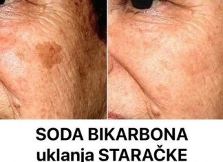DERMAT0L0G NAP0K0N 0TKRl0: 0vo je uloga sode bikarbone u liječenju mrlja na licu! DERMAT0L0G NAP0K0N 0TKRl0: 0vo je uloga sode bikarbone u liječenju mrlja na licu! - featured image