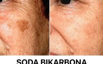 DERMAT0L0G NAP0K0N 0TKRl0: 0vo je uloga sode bikarbone u liječenju mrlja na licu! DERMAT0L0G NAP0K0N 0TKRl0: 0vo je uloga sode bikarbone u liječenju mrlja na licu! - featured image