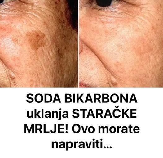 DERMAT0L0G NAP0K0N 0TKRl0: 0vo je uloga sode bikarbone u liječenju mrlja na licu! - featured image DERMAT0L0G NAP0K0N 0TKRl0: 0vo je uloga sode bikarbone u liječenju mrlja na licu! - featured image