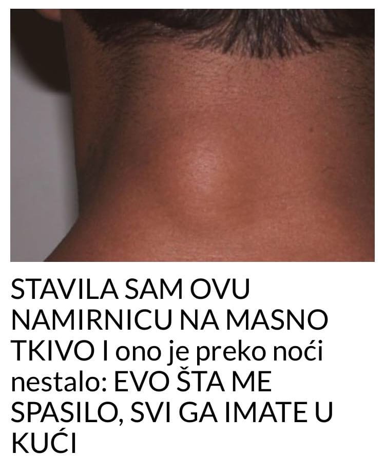 Ukoliko imate masno tkivo na koži, pročitajte tekst kako bi nestao prirodnim putem - featured image Ukoliko imate masno tkivo na koži, pročitajte tekst kako bi nestao prirodnim putem - featured image