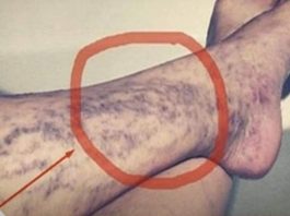 Svatko kod kuće ima lijek za popucale kapilare, ali mnogi ljudi to ne znaju! Svatko kod kuće ima lijek za popucale kapilare, ali mnogi ljudi to ne znaju! - featured image