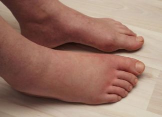 Ključni VITAMIN za uklanjanje OTEKLINA NOGU, NOŽNIH ZGLOBOVA I STOPALA! Ključni VITAMIN za uklanjanje OTEKLINA NOGU, NOŽNIH ZGLOBOVA I STOPALA! - featured image