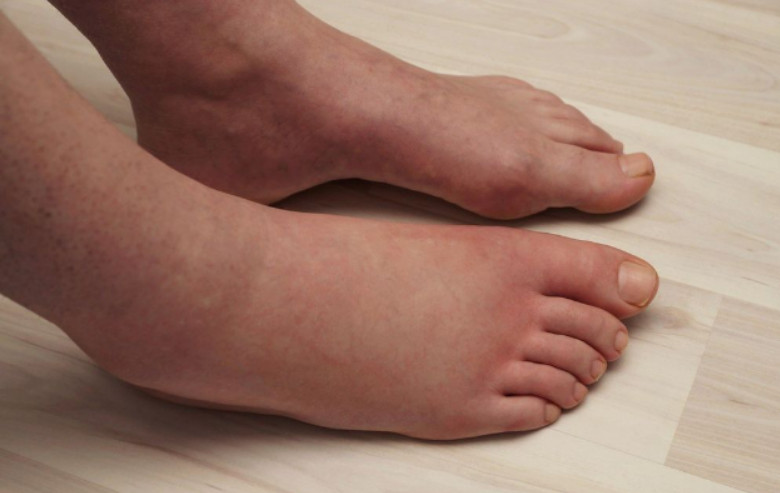 Ključni VITAMIN za uklanjanje OTEKLINA NOGU, NOŽNIH ZGLOBOVA I STOPALA! - featured image Ključni VITAMIN za uklanjanje OTEKLINA NOGU, NOŽNIH ZGLOBOVA I STOPALA! - featured image