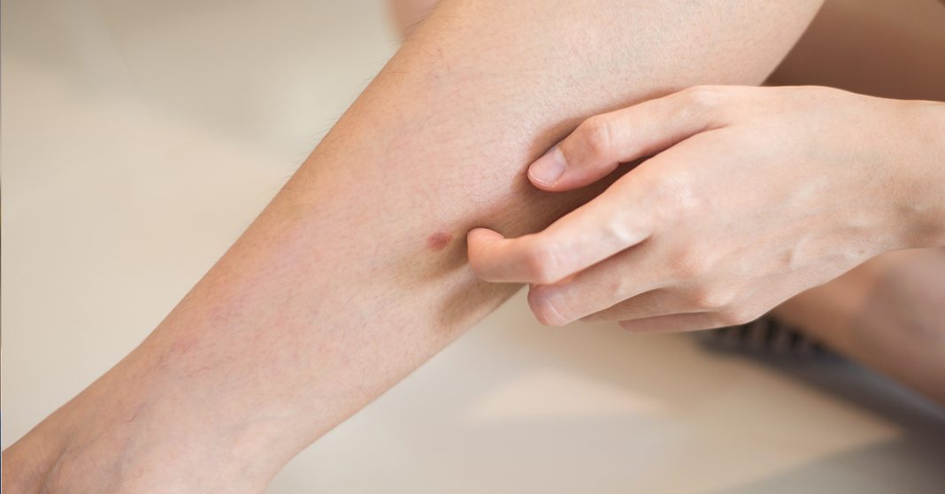 „Šta uzrokuje svrab na različitim dijelovima tijela: kada je bezopasan, a kada potražiti savjet ljekara“ - featured image „Šta uzrokuje svrab na različitim dijelovima tijela: kada je bezopasan, a kada potražiti savjet ljekara“ - featured image