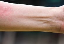 Ubod stršljena ga odveo na rub smrti,Ispovijest muškarca kojeg je napao roj stršljena ledi krv u žilama: “Srce mi je prestalo kucati, ali čudo me vratilo!