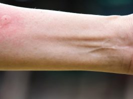 Ubod stršljena ga odveo na rub smrti,Ispovijest muškarca kojeg je napao roj stršljena ledi krv u žilama: “Srce mi je prestalo kucati, ali čudo me vratilo!