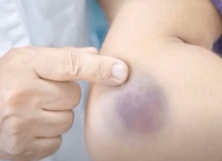 NIKAD NE BISTE POGODILI ZAŠTO SE MODRICE JAVLJAJU PO TIJELU: Nema veze sa POVREDAMA, PRAVI RAZLOGĆE VAS ŠOKIRATI NIKAD NE BISTE POGODILI ZAŠTO SE MODRICE JAVLJAJU PO TIJELU: Nema veze sa POVREDAMA, PRAVI RAZLOGĆE VAS ŠOKIRATI - featured image