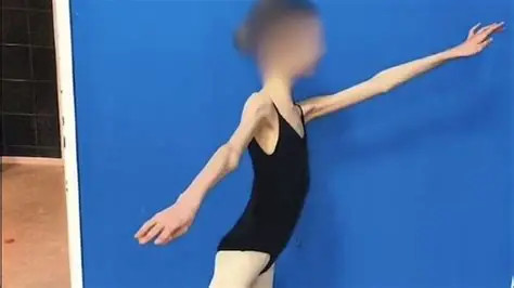 Devojčicu doveli u bolnicu, imala je samo 28 KG I RUČICE TANKE KAO GRISINE: Kad su lekari shvatili koliko ima godina, samo su se UHVATILI ZA GLAVU - featured image Devojčicu doveli u bolnicu, imala je samo 28 KG I RUČICE TANKE KAO GRISINE: Kad su lekari shvatili koliko ima godina, samo su se UHVATILI ZA GLAVU - featured image