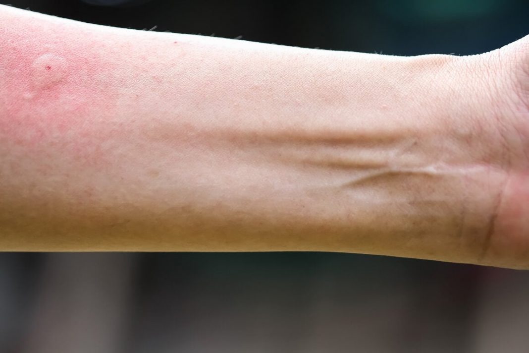Ubod stršljena ga odveo na rub smrti,Ispovijest muškarca kojeg je napao roj stršljena ledi krv u žilama: “Srce mi je prestalo kucati, ali čudo me vratilo! - featured image Ubod stršljena ga odveo na rub smrti,Ispovijest muškarca kojeg je napao roj stršljena ledi krv u žilama: “Srce mi je prestalo kucati, ali čudo me vratilo! - featured image